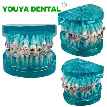 Zobni Ortodontskega Model S Kovinski In Keramični Oklepajih Oklepaji Zobozdravstvo Model Poučevanja Poučevanje Študija Demo Za Bolnike Študentov